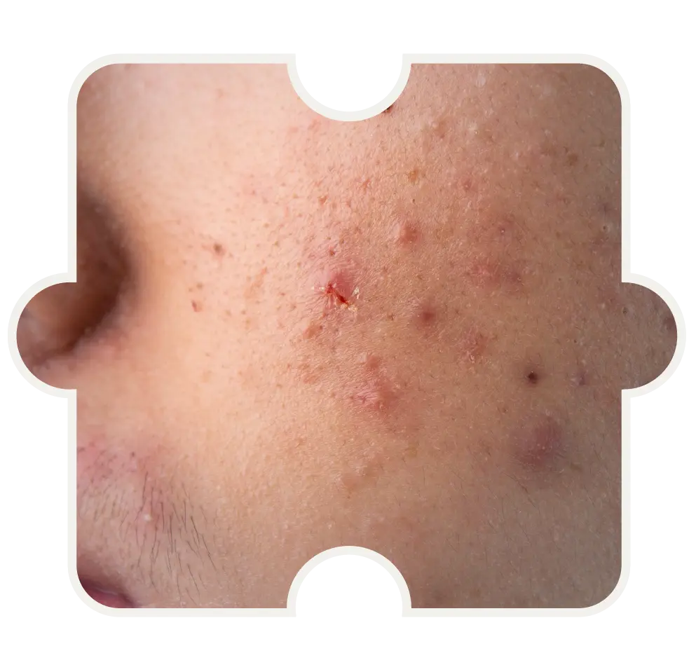Haut mit entzündeten Pickeln und Unreinheiten – TCM-Behandlung bei Akne