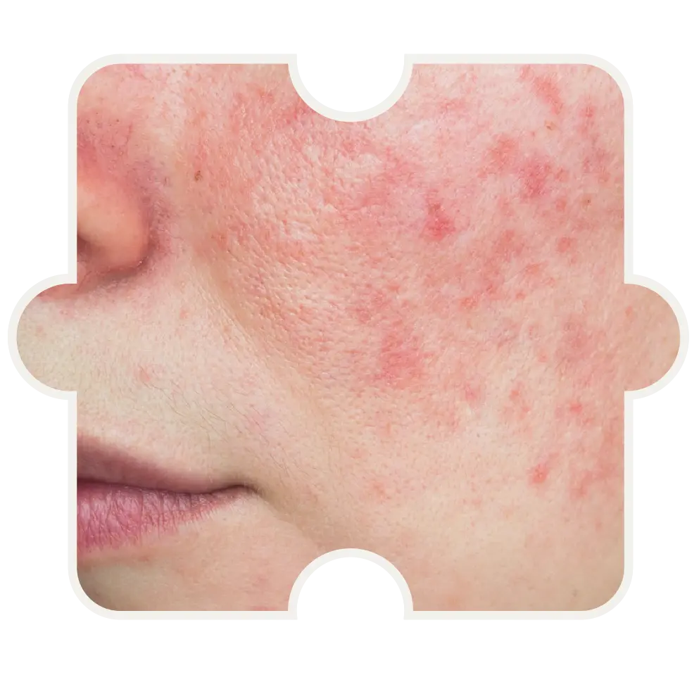 Wange mit geröteter Haut und feinen Pusteln – TCM-Behandlung bei Rosacea