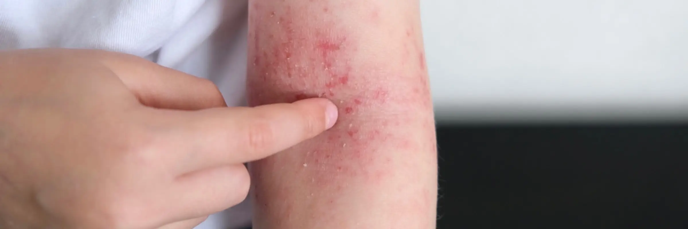 Trockene, gerötete Haut in der Armbeuge – TCM-Behandlung bei Neurodermitis