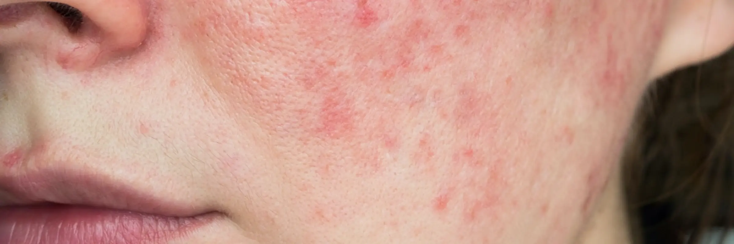 Wange mit geröteter Haut und feinen Pusteln – TCM-Behandlung bei Rosacea